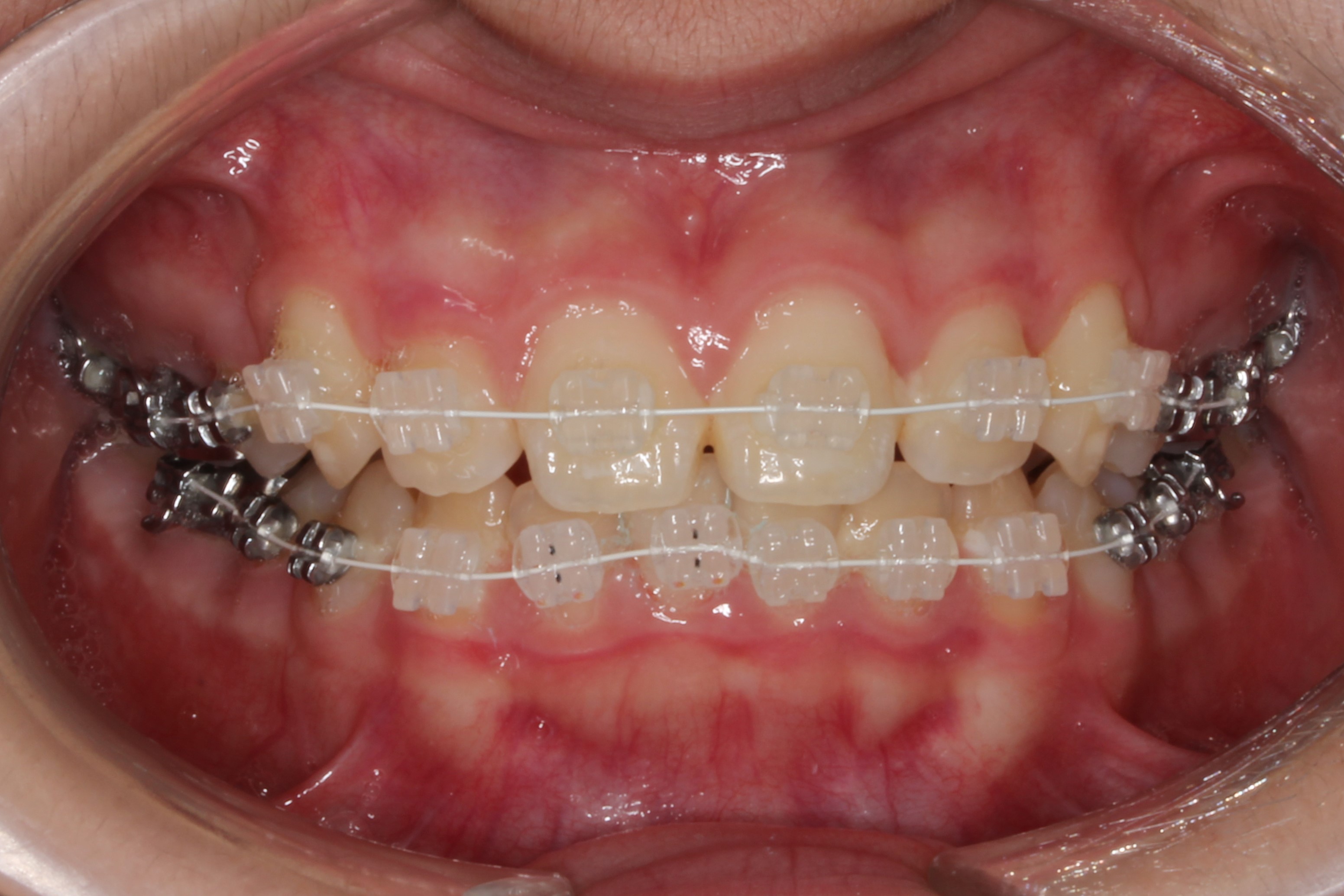 マルチブラケット装置の原型 | 葛西ジェム矯正歯科