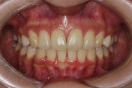 矯正治療後の歯並び