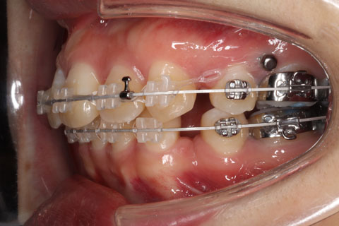 固定源となる歯科矯正用アンカースクリュー| 葛西ジェム矯正歯科