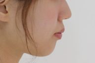 20代　女性　出っ歯　口が閉じにくい