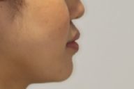 10代　女性　口元が出ている